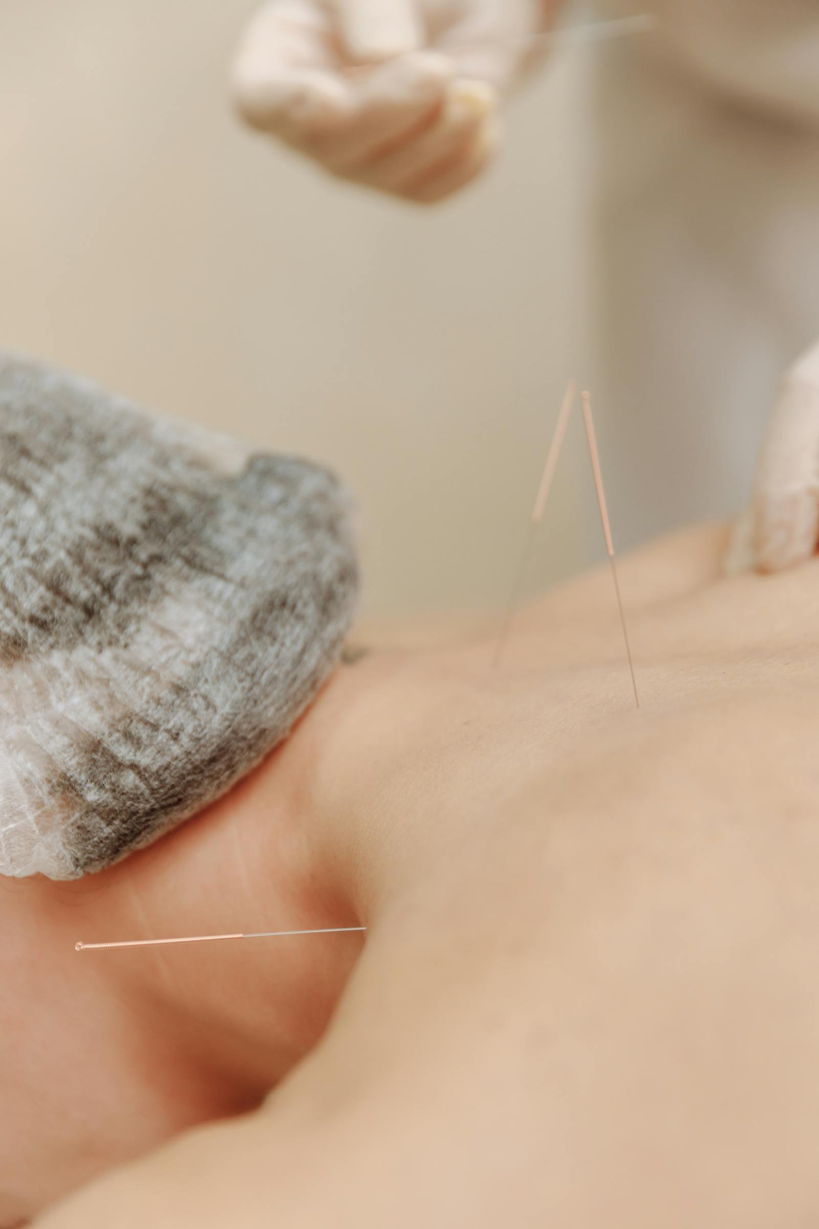 Acupuncture session at it's herbs